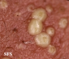 folliculitis of barbae
