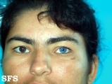 oculocutaneous albinism