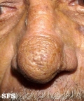 rinofima