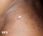 keratoacanthoma pendulum