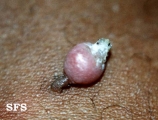 keratoacanthoma pendulum