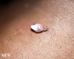 keratoacanthoma pendulum