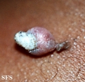 keratoacanthoma pendulum
