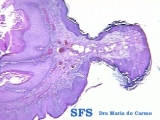 keratoacanthoma pendulum