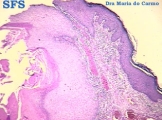 keratoacanthoma pendulum