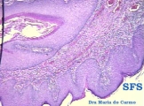 keratoacanthoma pendulum
