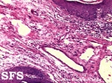 keratoacanthoma pendulum