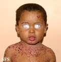 chronic bullous disease of childhood