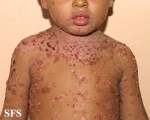 chronic bullous disease of childhood