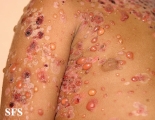 chronic bullous disease of childhood