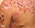 chronic bullous disease of childhood