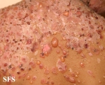 chronic bullous disease of childhood