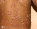 chronic bullous disease of childhood