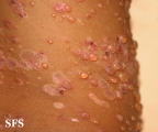 chronic bullous disease of childhood