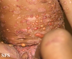 chronic bullous disease of childhood