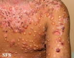 chronic bullous disease of childhood