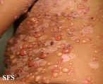chronic bullous disease of childhood
