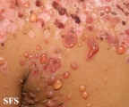 chronic bullous disease of childhood