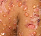 chronic bullous disease of childhood
