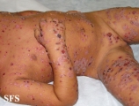 chronic bullous disease of childhood