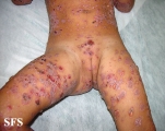 chronic bullous disease of childhood