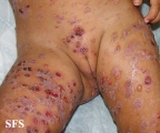 chronic bullous disease of childhood