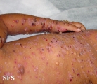 chronic bullous disease of childhood