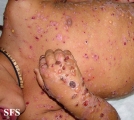 chronic bullous disease of childhood