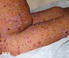 chronic bullous disease of childhood