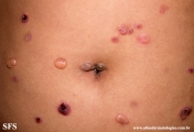 chronic bullous disease of childhood