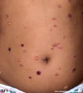 chronic bullous disease of childhood