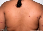 chronic bullous disease of childhood