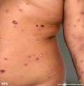 chronic bullous disease of childhood