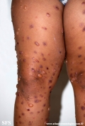 chronic bullous disease of childhood