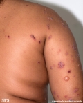 chronic bullous disease of childhood