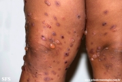 chronic bullous disease of childhood