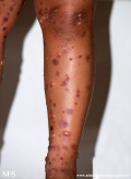chronic bullous disease of childhood