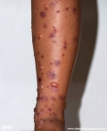 chronic bullous disease of childhood