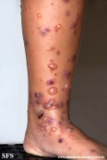 chronic bullous disease of childhood