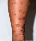 chronic bullous disease of childhood