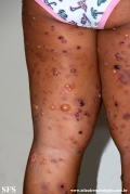 chronic bullous disease of childhood