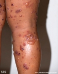 chronic bullous disease of childhood