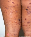 chronic bullous disease of childhood