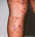 chronic bullous disease of childhood