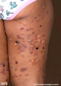 chronic bullous disease of childhood