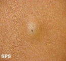 cyst epidermoid