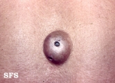 cyst epidermoid