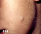 cyst epidermoid