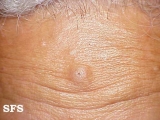 cyst epidermoid