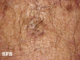 cyst epidermoid